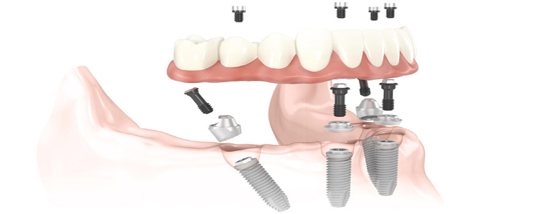 Best dental treatment in vibhuti khand lko